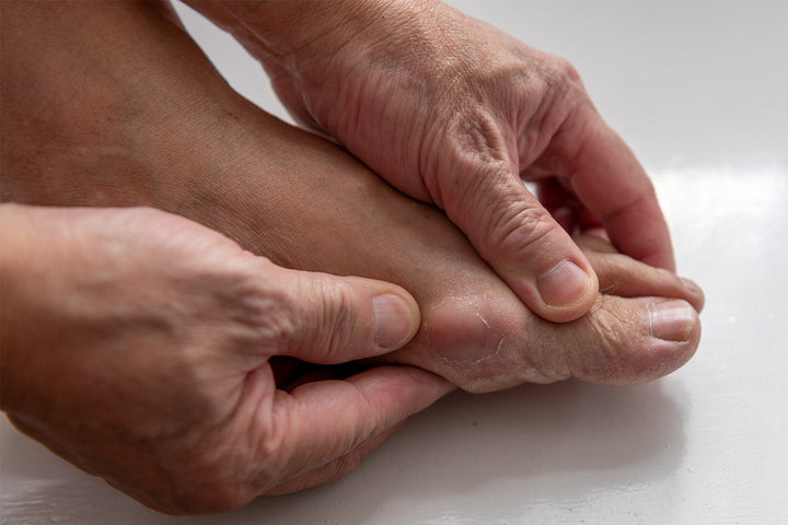 Hallux rigidus (stel stortåled)