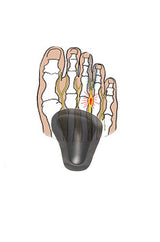 Självhäftande pelotter för nedsjunket främre fotvalv