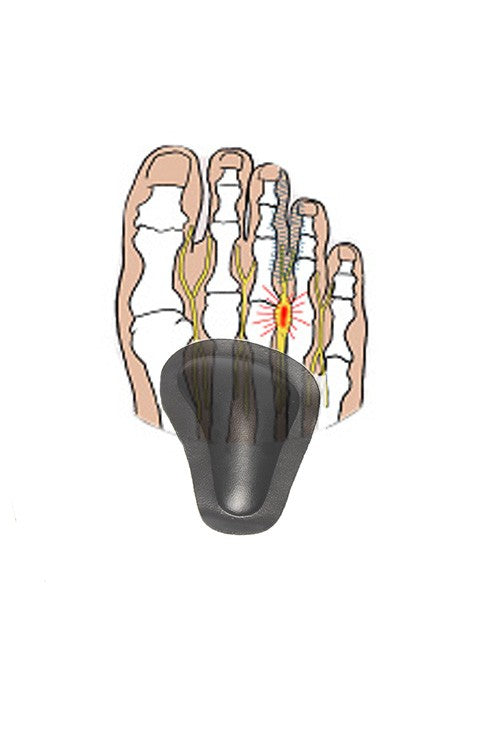 Självhäftande pelotter för nedsjunket främre fotvalv