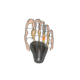 Självhäftande pelotter för nedsjunket främre fotvalv