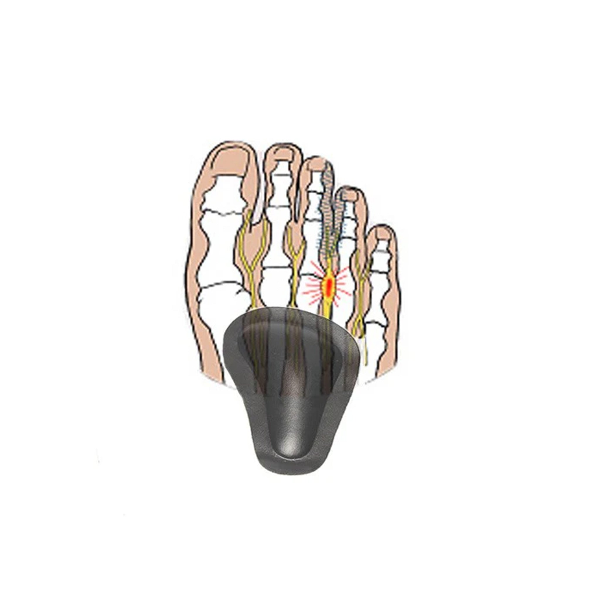 Självhäftande pelotter för nedsjunket främre fotvalv